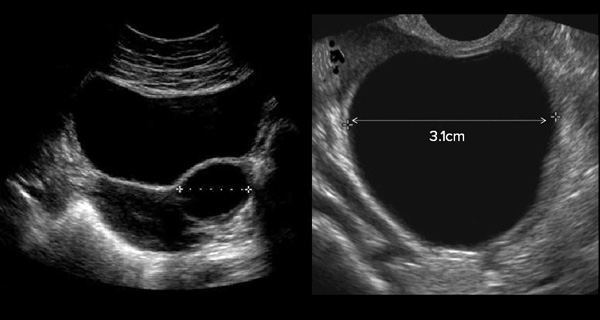 Как выглядит киста желтого тела яичника на узи фото