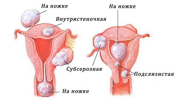 Основные виды фибромиом