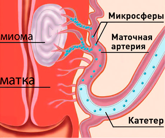 Эмболизация маточных артерий