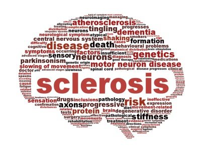 Обострение рассеянного склероза: что это такое?