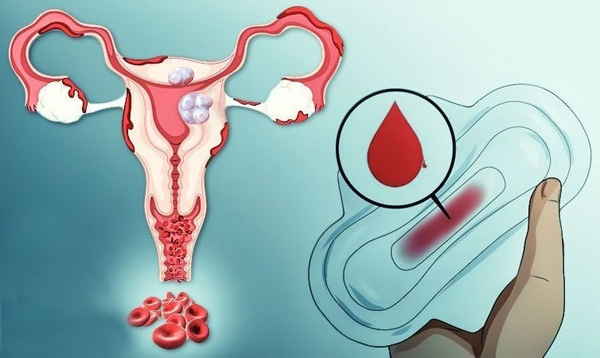 Маточное кровотечение как симптом наличия миоматозных узлов