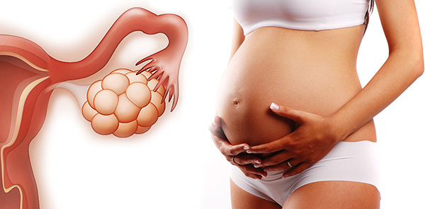 Поговорим про особенности планирования и течения беременности при синдроме поликистозных яичников...