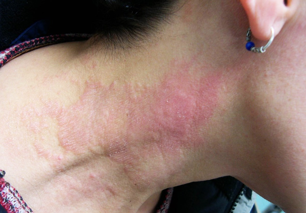 Аллергия на боровую матку