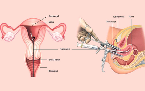 Выскабливание матки при эндометриозе
