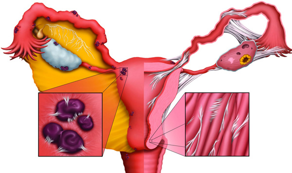 Спаечные процессы часты при эндометриозе