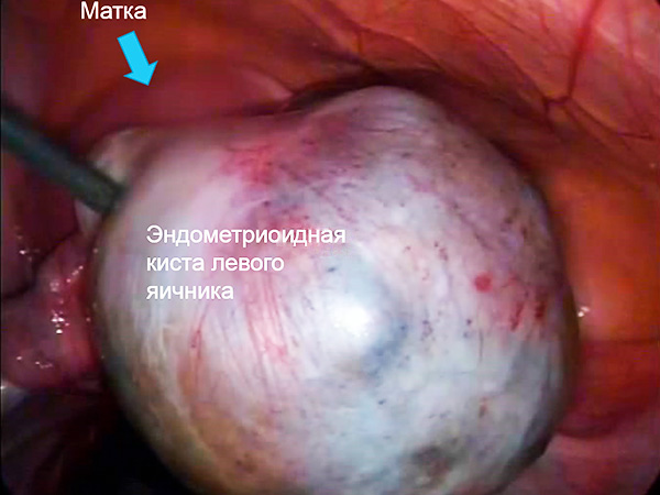 Эндометриоидное образование на левом яичнике во время операции