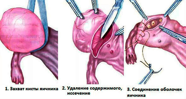Этапы проведения операции по удалению кисты яичника