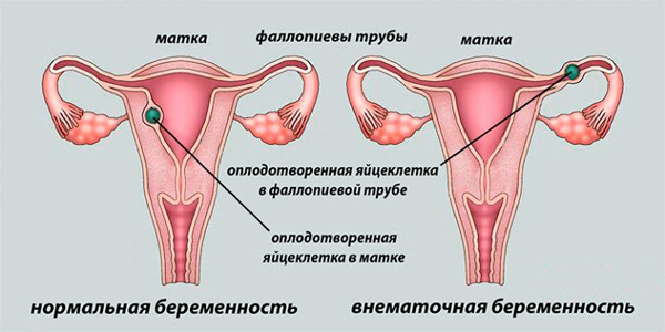 Аденомиоз может спровоцировать внематочную беременность