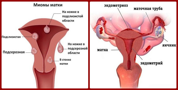 Миома и эндометриоз