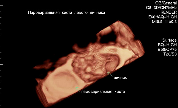 Параовариальная киста и яичник в 3D-проекции на УЗИ
