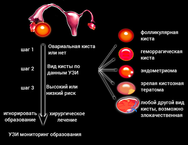 Обследование при кисте яичника