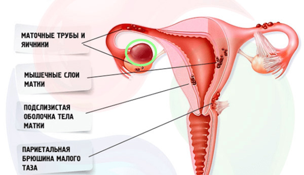 Эндометриоз и эндометриоидная киста могут стать причиной бесплодия