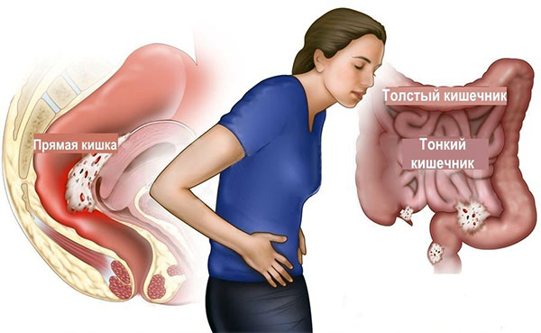 Эндометриоз кишечника в большинстве случаев говорит о тяжелой стадии эндометриоза