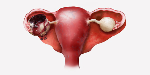 Посмотрим, какую опасность разрыв кисты яичника может представлять для здоровья женщины...