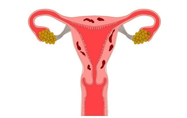 Поговорим об особенностях протекания эндометриоза тела матки и подходах к его лечению...