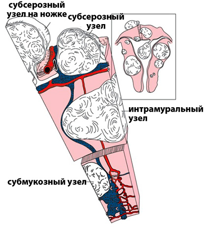 Расположение различных миоматозных узлов в разрезе