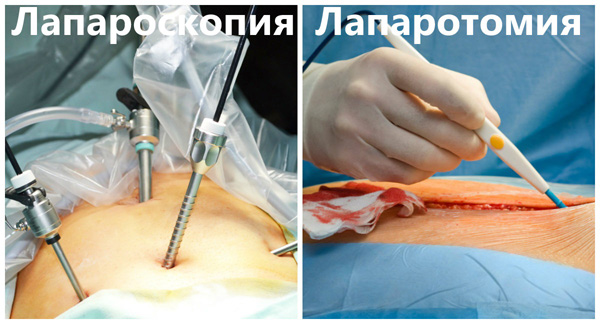 Лапароскопия и лапаротомия