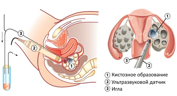 Схематичное изображение процедуры пункции кисты яичника