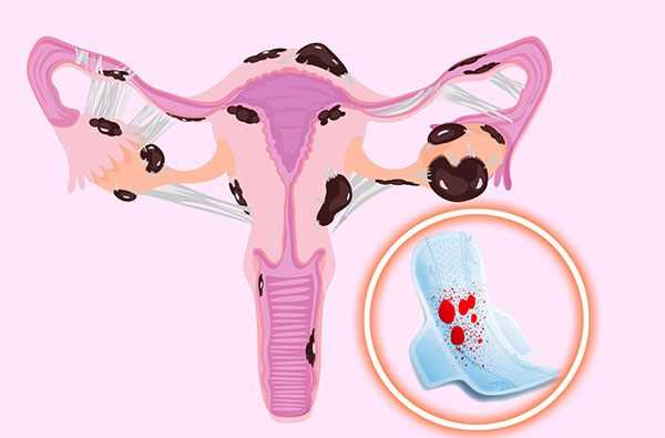 Выясняем, как при эндометриозе меняется менструальный цикл и какими выделениями проявляет себя данная патология...