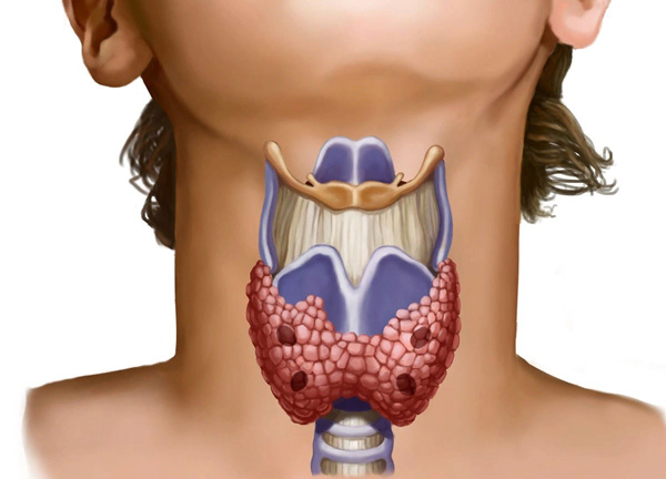 Сбой в работе щитовидной железы может стать причиной СПКЯ