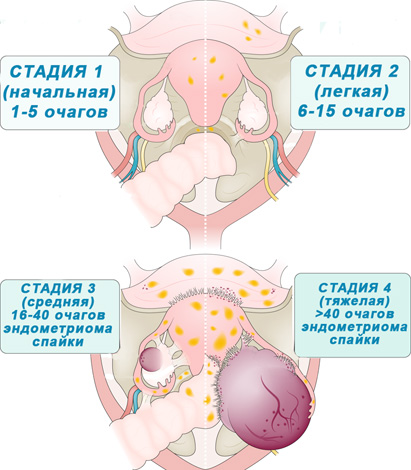 Стадии развития эндометриоза