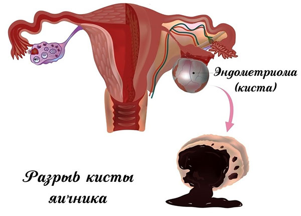 Разрыв эндометриомы