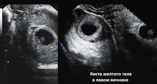 Лютеиновая киста на левом яичнике (УЗИ-снимок)