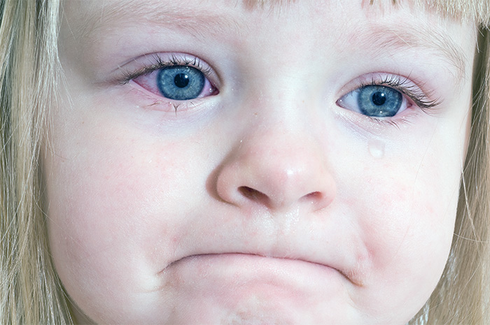 воспаление глаз у ребенка