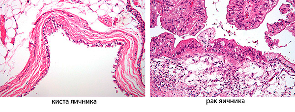 Гистологическое строение кисты и рака яичника