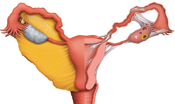 Непроходимость маточных труб как одна из причин бесплодия