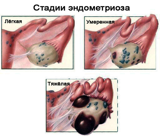 3 стадии эндометриоза