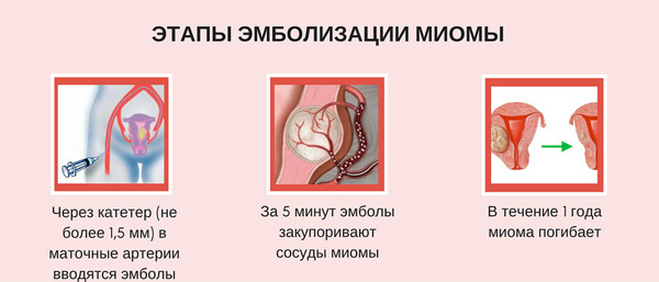 Эмболизация маточных артерий 