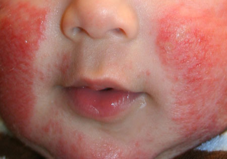 Аллергический дерматит фото у детей на руках