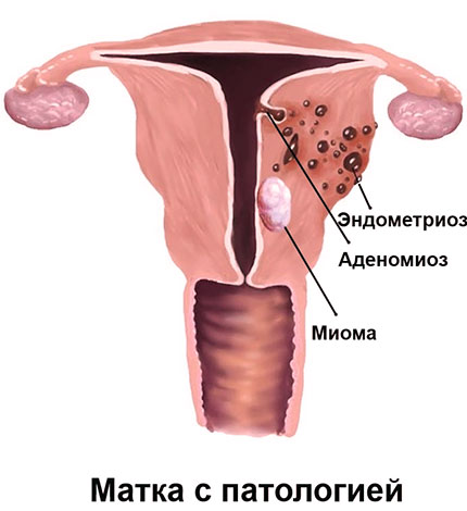 При сочетании эндометриоза с миомой Дюфастон применяют редко