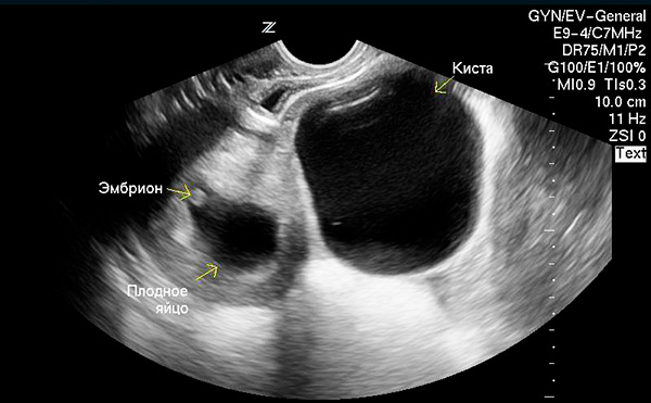 УЗИ-снимок беременности и кисты яичника