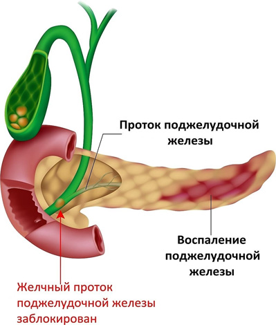 Воспаление поджелудочной железы при поликистозе