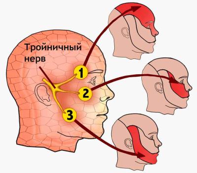 Невралгия тройничного нерва: симптомы и проявления