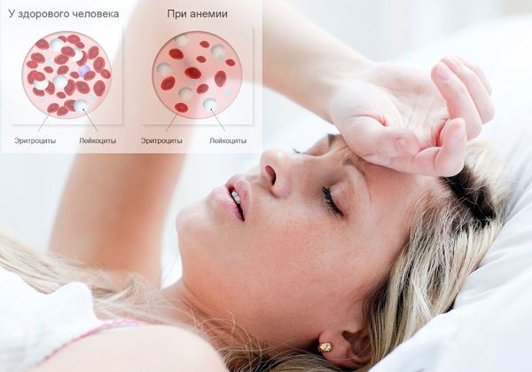Анемия часто возникает при патологических маточных кровотечениях