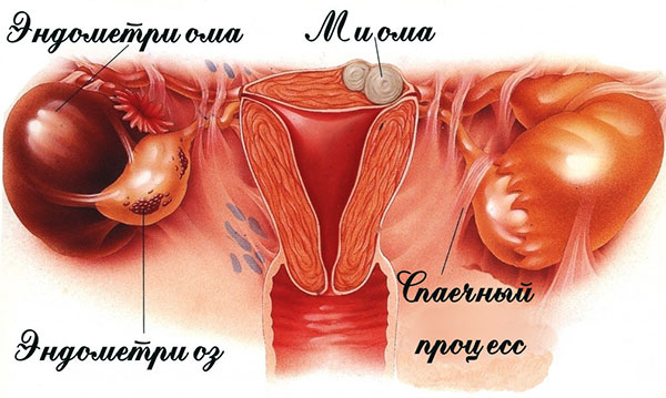 Эндометриоз в сочетании с миомой матки