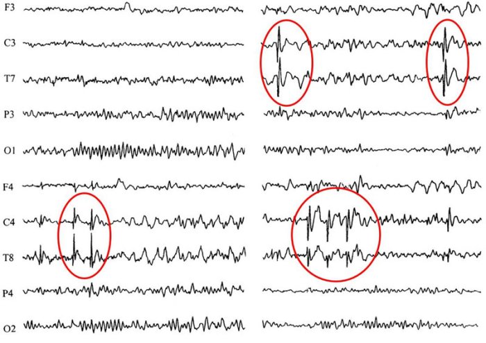Диагноз эпилепсия: эпилептическая активность на ЭЭГ