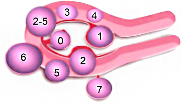 Классификация миоматозных узлов FIGO