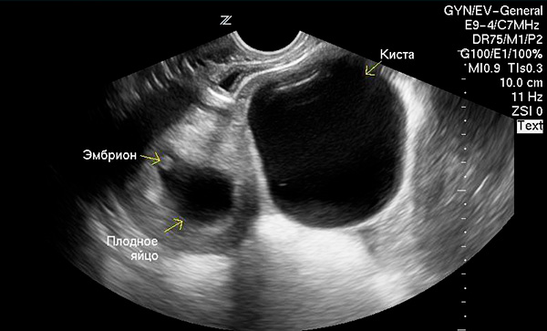 Фолликулярная киста и беременность на снимке УЗИ
