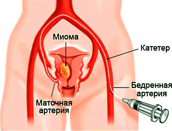 Эмболизация маточных артерий 