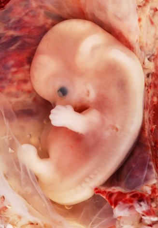 Эмбрион при аденомиозе не получает достаточного питания
