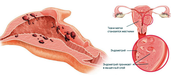 Схематичное изображение аденомиоза