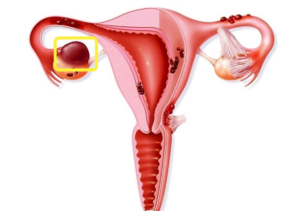 Эндометриоидная киста поддается лечению медикаментами на начальной стадии развития