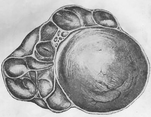 Многокамерная киста яичника схематично в разрезе
