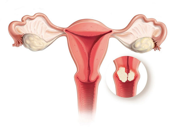 Рак шейки матки могут не заметить из-за наличия эндоцервикальных кист