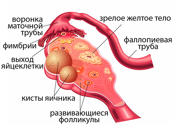 Размер кистозных образований по отношению к зрелому желтому телу яичника