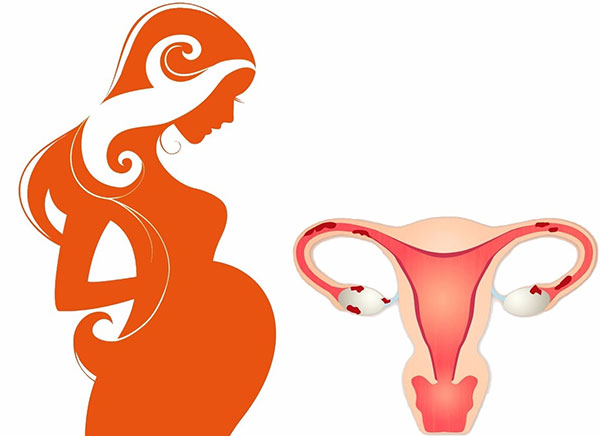 Выясняем, возможна ли беременность при эндометриозе и как она протекает...